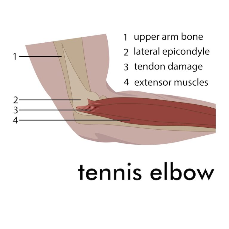 Tennis elbow | action rehab