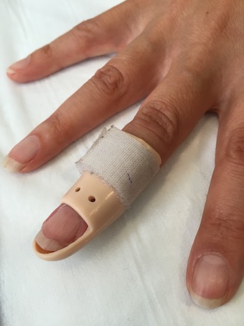 Mallet finger treatment - mallet finger splint