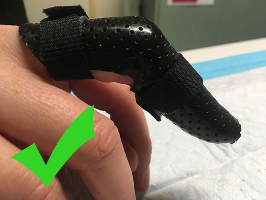 Tendon injury - mallet finger anti swan neck splint