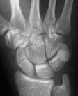 Scaphoid fracture imaging