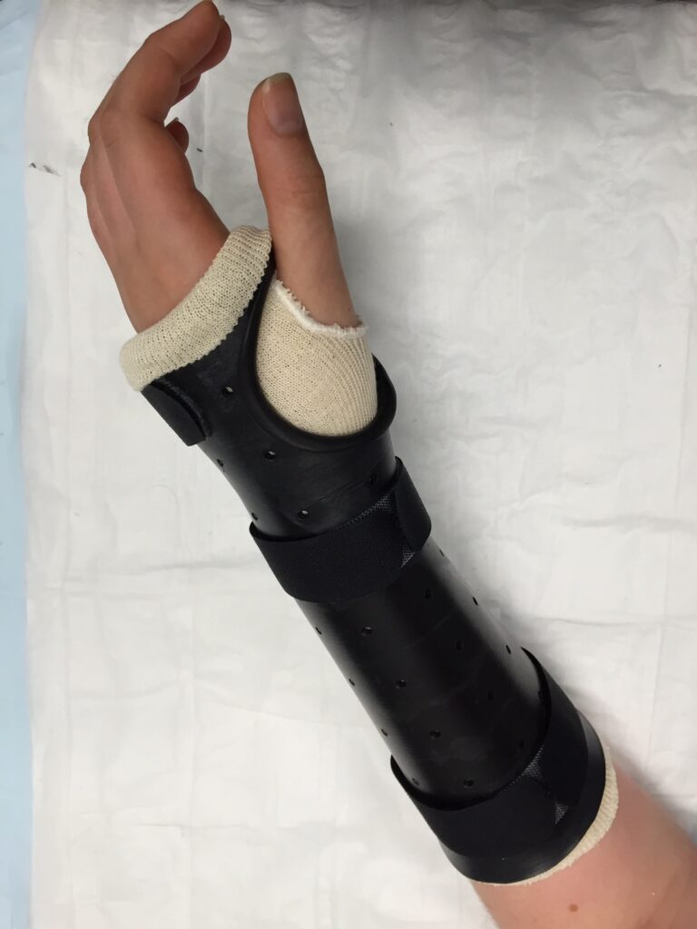 Long opponens splint for scaphoid fracture | action rehab