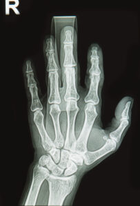 Wrist and hand xrays - fracture bone on finger splint