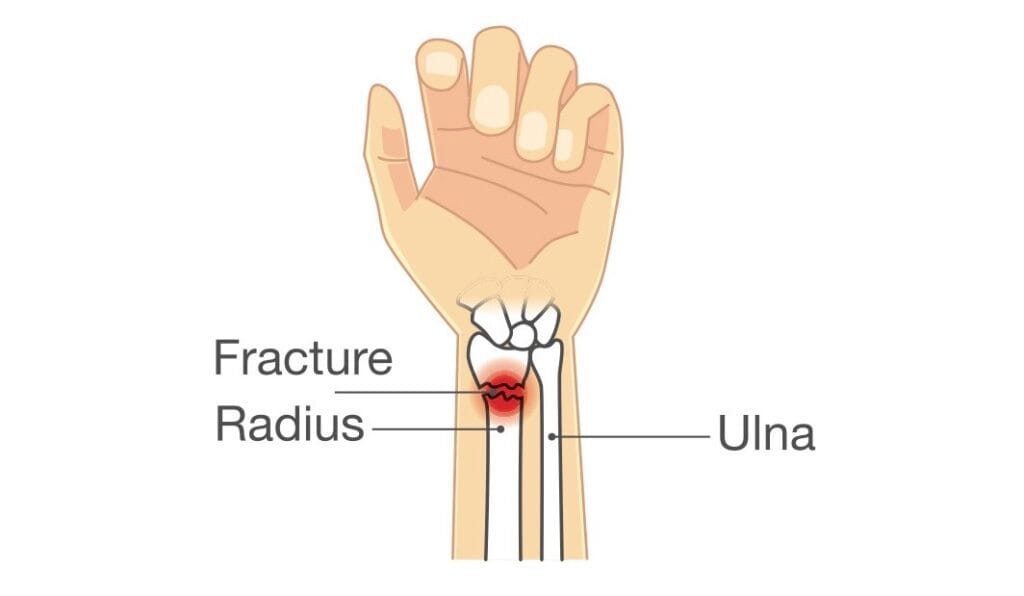 Wrist fracture treatment | action rehab