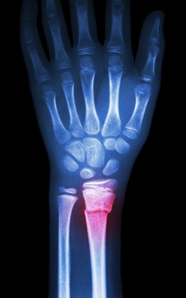 Wrist fracture xray - fracture distal radius | action rehab