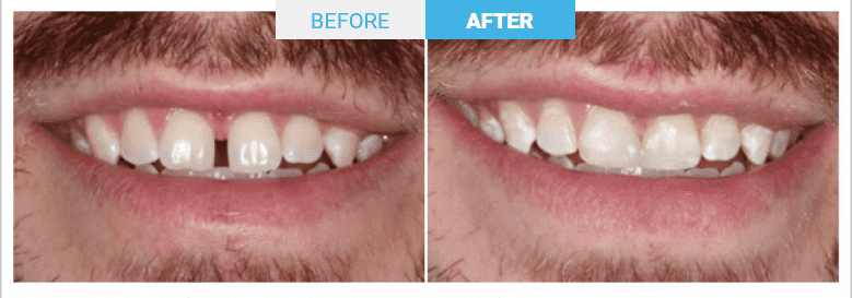 All about front tooth filling