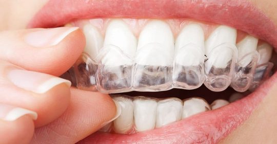 home teeth whitening safe