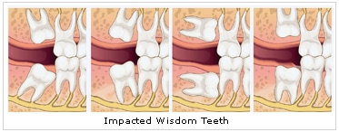 wisdom_teeth_removal_dentistry_service_dental_care_professionals wisdom teeth removal dentistry service dental care professionals