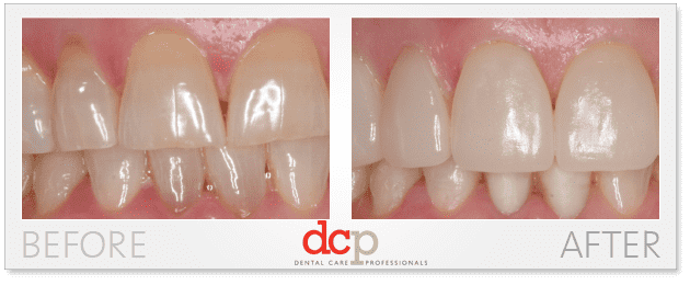 before-after-cerec-veneers veeners before and after