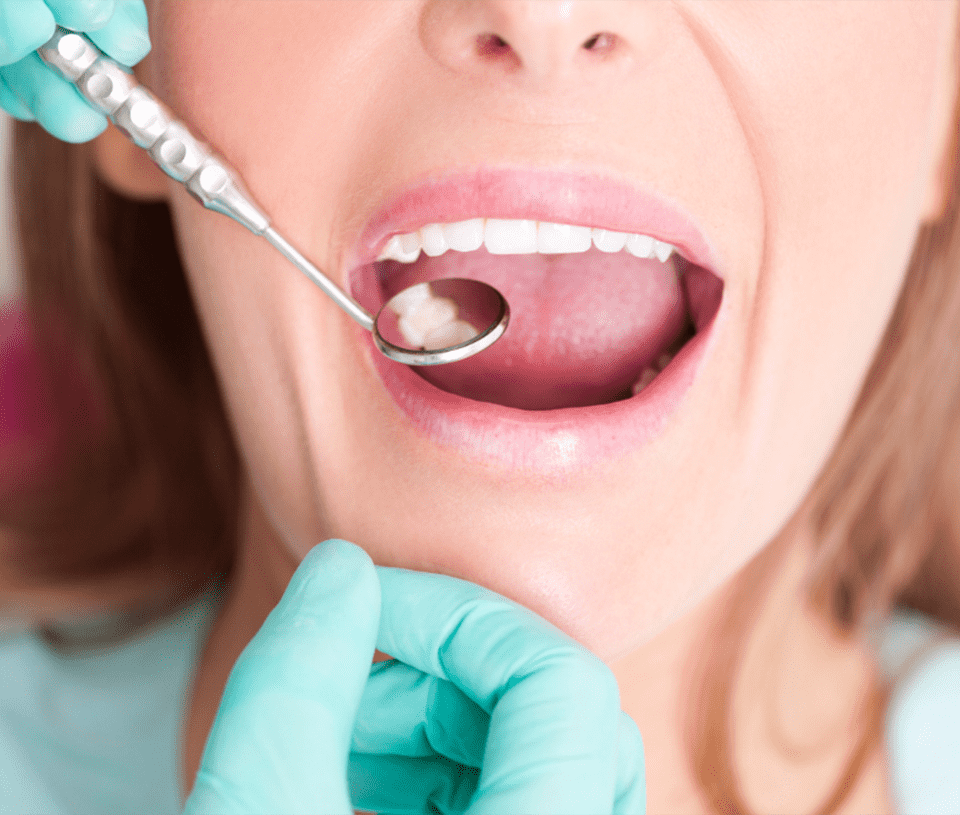 iStock-514771081 Fissure Sealants