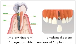 implant_dentistry_dental_care_professionals Dental Implants