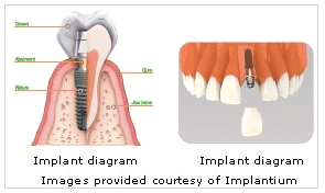 Dental Implants in Adelaide
