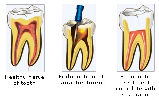 Root Canal Treatment in Adelaide
