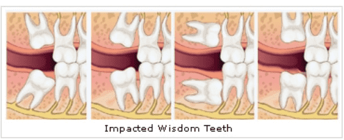 Wisdom Teeth Removal in Adelaide
