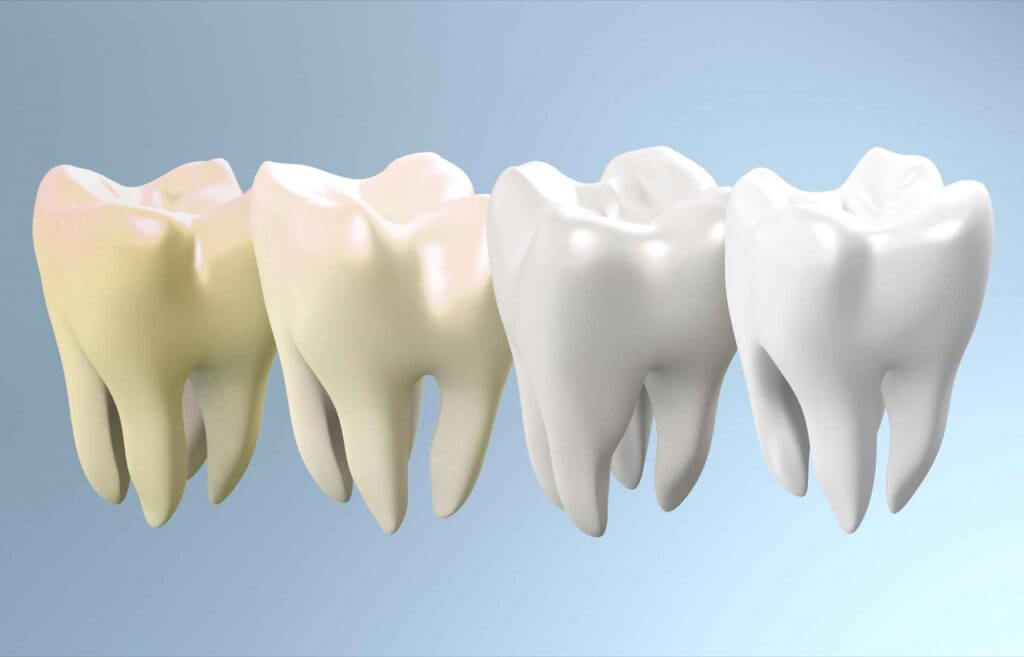 Different shades of teeth colour