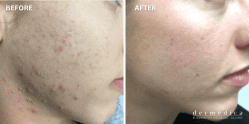 Effective Acne Scar Treatment Perth: Clear Skin Solutions