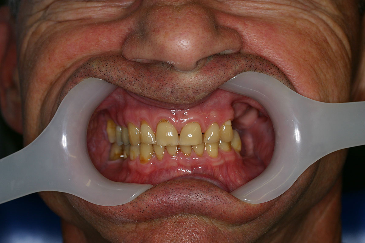 Posterior bridge and single molars Dr Zielinski & Associates