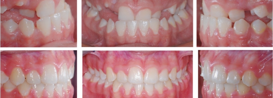 Before And After 01 Anterior