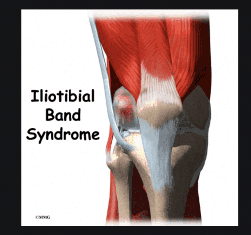 Iliotibial Band Syndrome - Enhance Physiotherapy