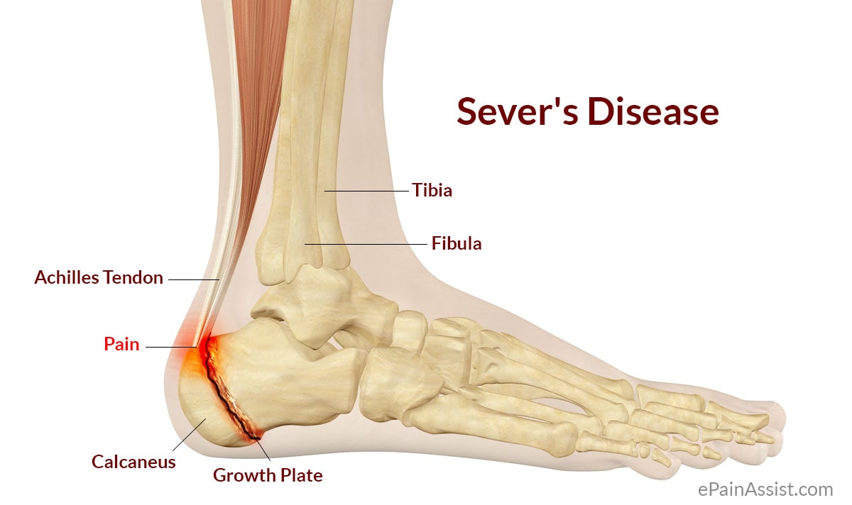 Stretching exercises for sever's disease shop