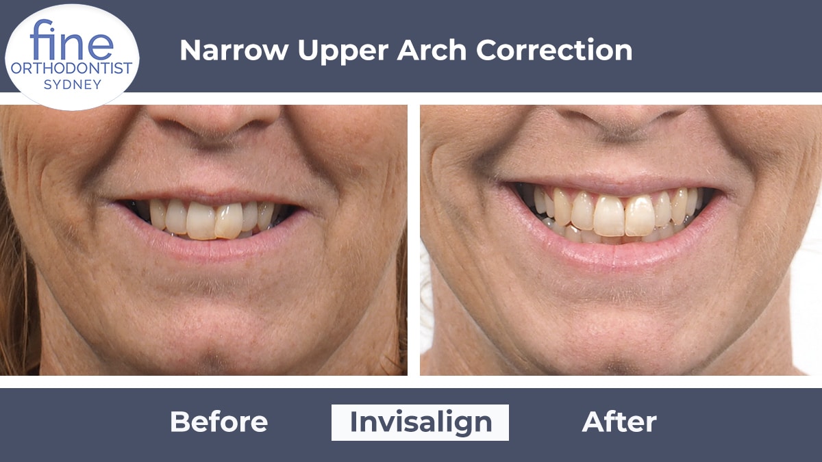 Invisalign Orthodontist Near Me Inwood thumbnail