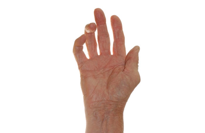 Finger Arthritis Treatment | Action Rehab Hand Therapy Clinic