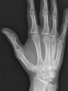 Metacarpal Fracture Xray | Action Rehab Hand Therapy Clinic