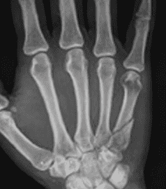 Metacarpal Fracture Xray | Action Rehab Hand Therapy Clinic