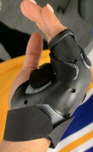 Metacarpal Fracture Splint | Action Rehab Hand Therapy Clinic