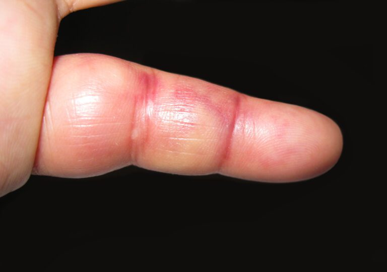 finger injury, swollen, bruised and inflamed after a joint dislocation