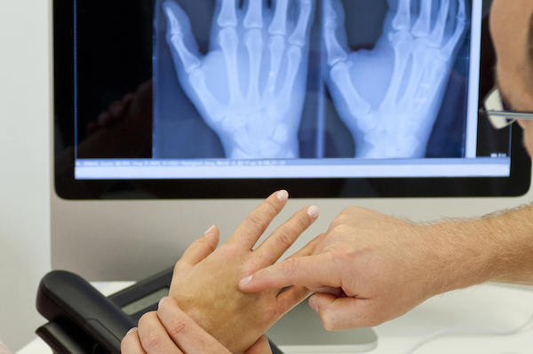 Metacarpal Fracture Treatment Melbourne | Action Rehab Hand Therapy Clinic