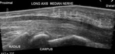 Carpal Tunnel Syndrome Imaging