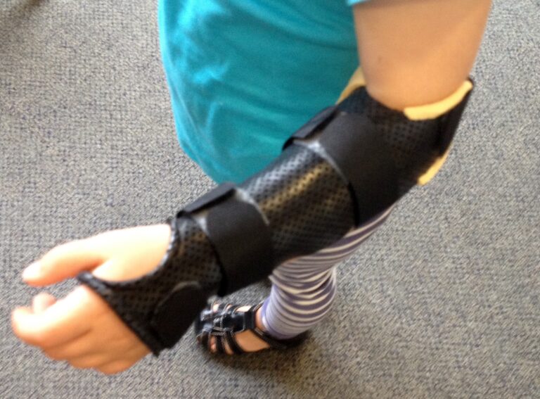 Custom Hand Splints and Casts for Injuries | Action Rehab Hand Therapy Clinic