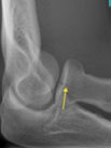 Radial Head Fracture Imaging