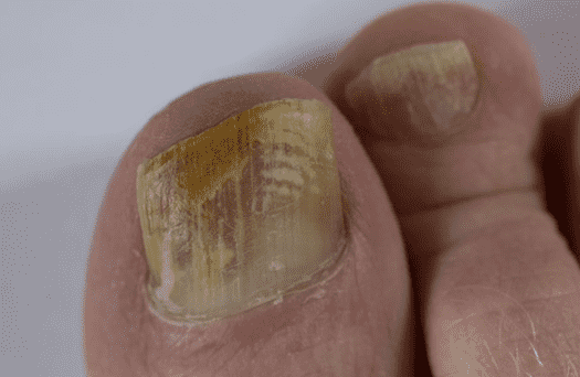 Onychomycosis (fungal nail infection)