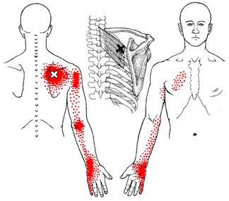 What are Muscle knots and muscle trigger points and how do you get rid of  them? - Inertia Health Group Adelaide
