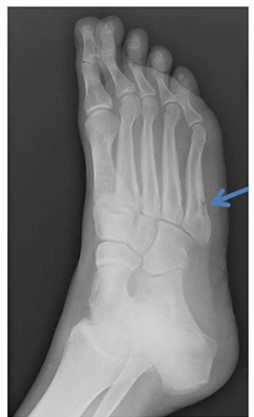 Physiotherapy Management of Stress Fractures & Stress Reactions ...