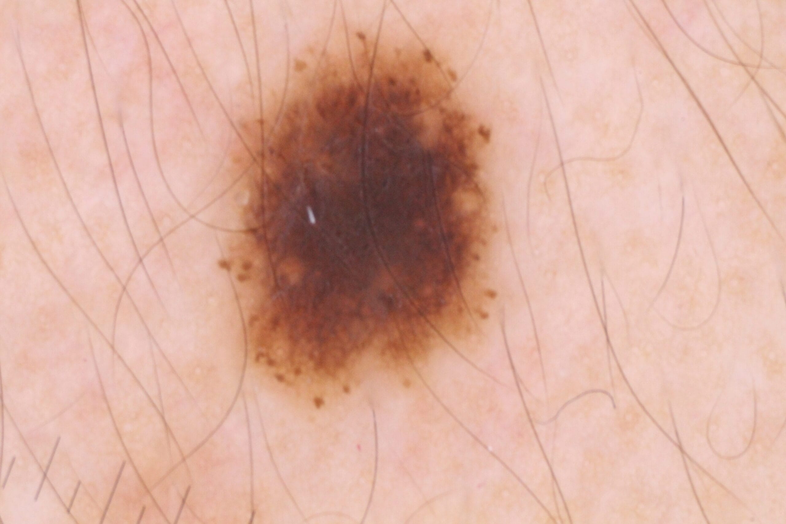 possible skin cancer