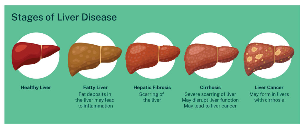 Diagram showing the stages of liver disease - healthy liver, fatty liver, hepatic fibrosis, cirrhosis, liver cancer