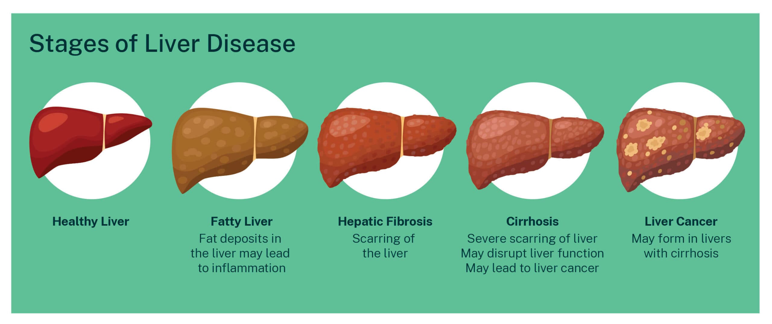 Liver Diseases List Liver Foundation 4166