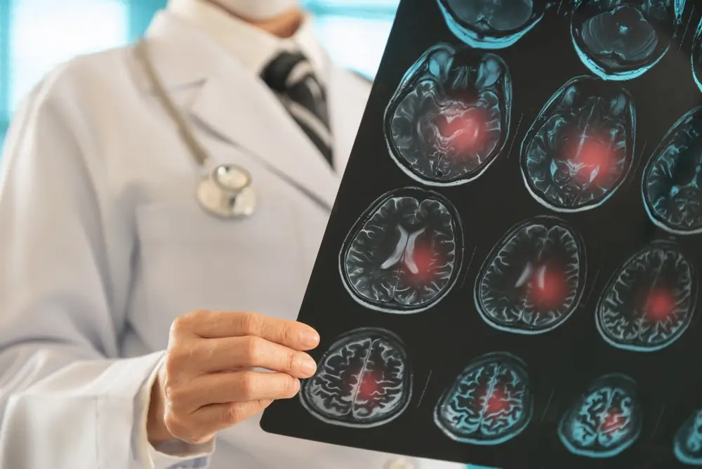 Radiology Doctor reviewing x-ray image to diagnose a stroke