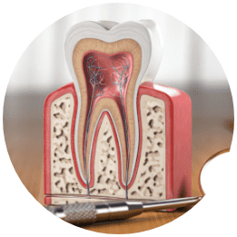 Root Canal