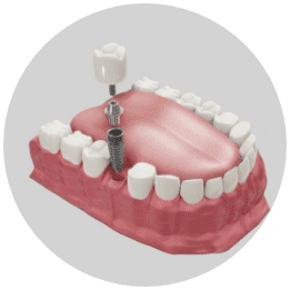 Dental implant