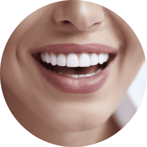 Veneer Main