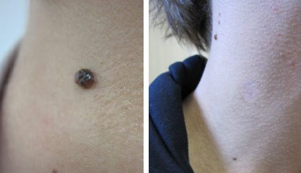 Mole Removal Before & After 4