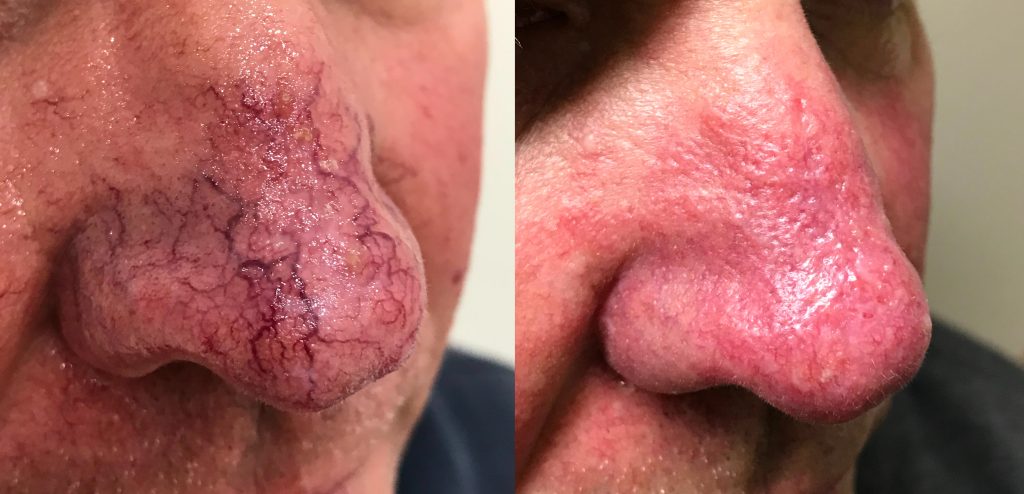 Rosacea Before & After 2