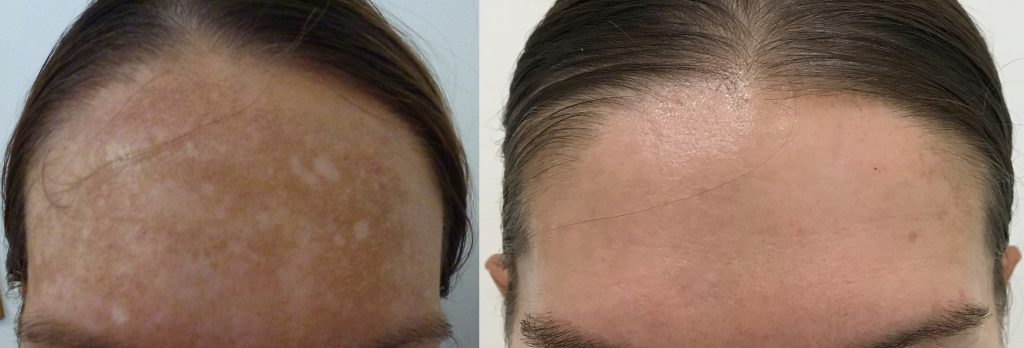 Pigmentation Before & After