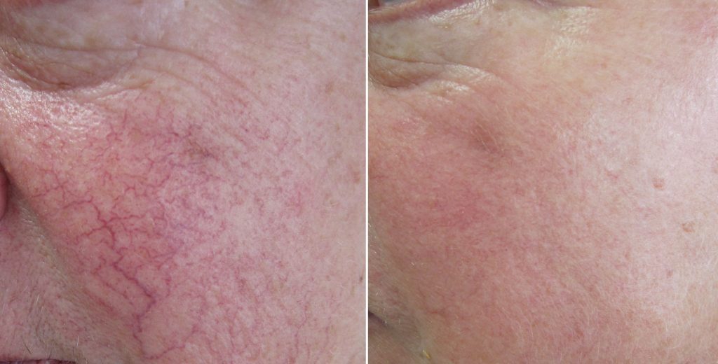 Capillary Rosacea Before & After 3